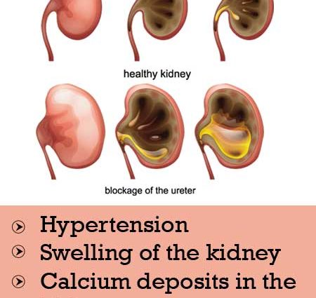 Tuberculosis of the urinary system &#8211; causes, symptoms, treatment