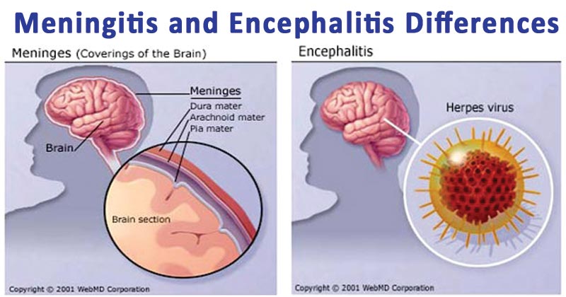 Tuberculous meningitis and encephalitis