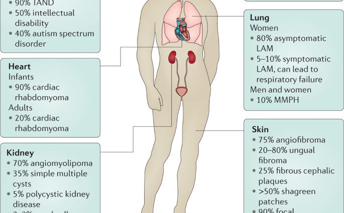 Tuberous sclerosis &#8211; symptoms, causes, treatment