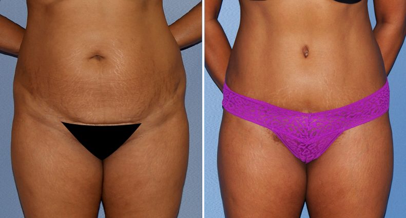 Tummy tuck &#8211; the course of the procedure, indications, contraindications, complications