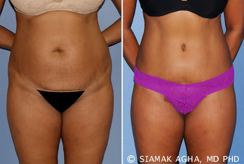 Tummy tuck &#8211; the course of the procedure, indications, contraindications, complications