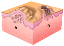 Tumors and nodules