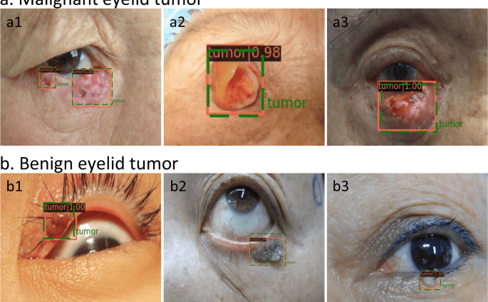 Tumors of the eyelids