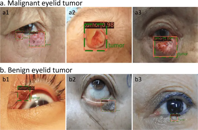 Tumors of the eyelids