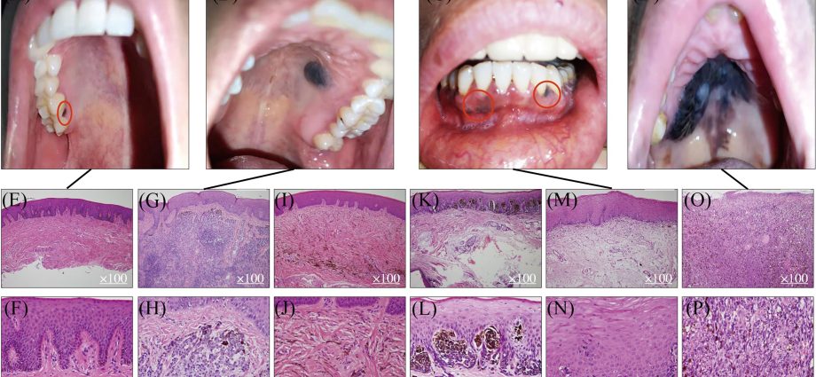 Tumors of the mucosa and skin &#8211; types, symptoms, treatment, photos