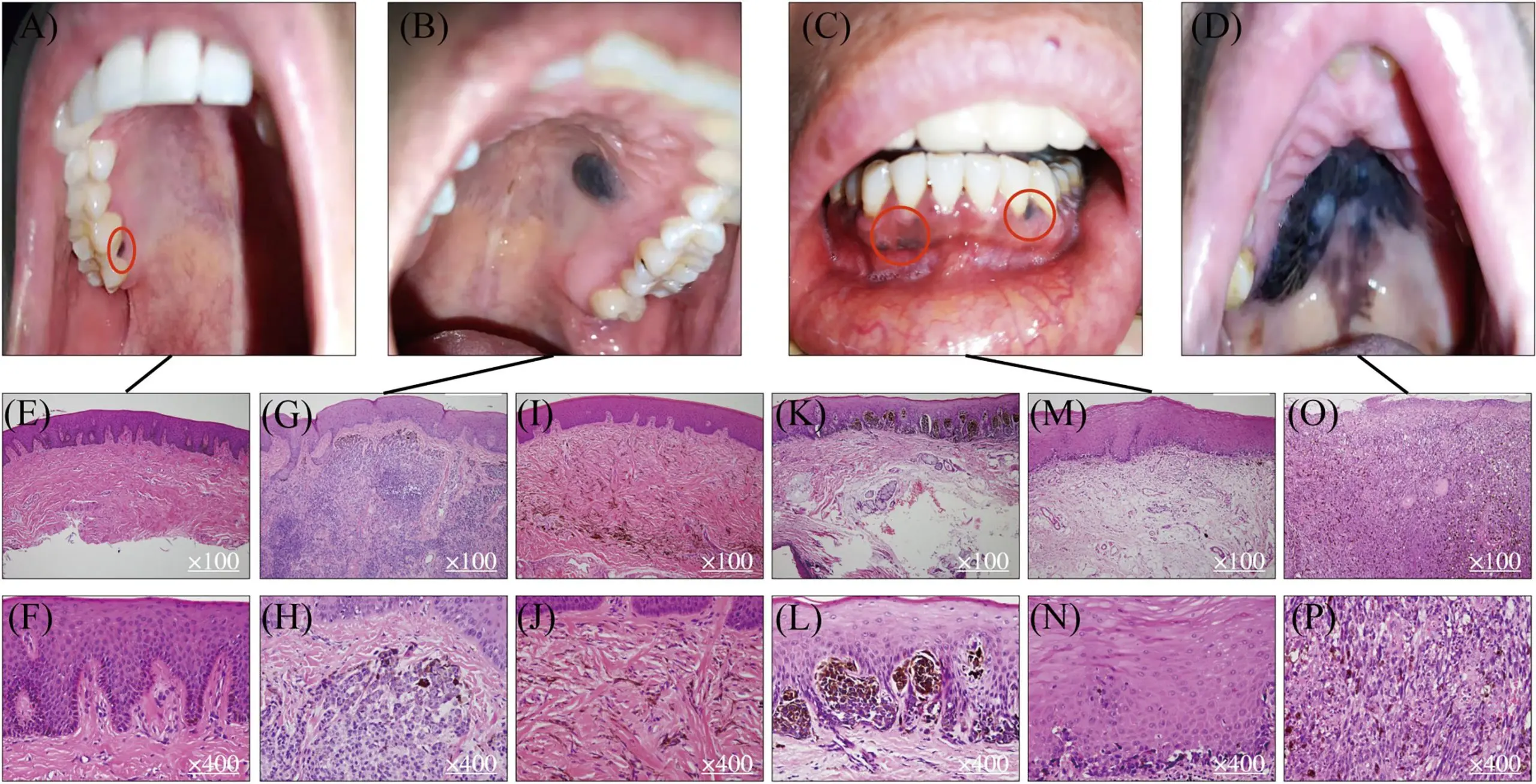 Tumors of the mucosa and skin &#8211; types, symptoms, treatment, photos