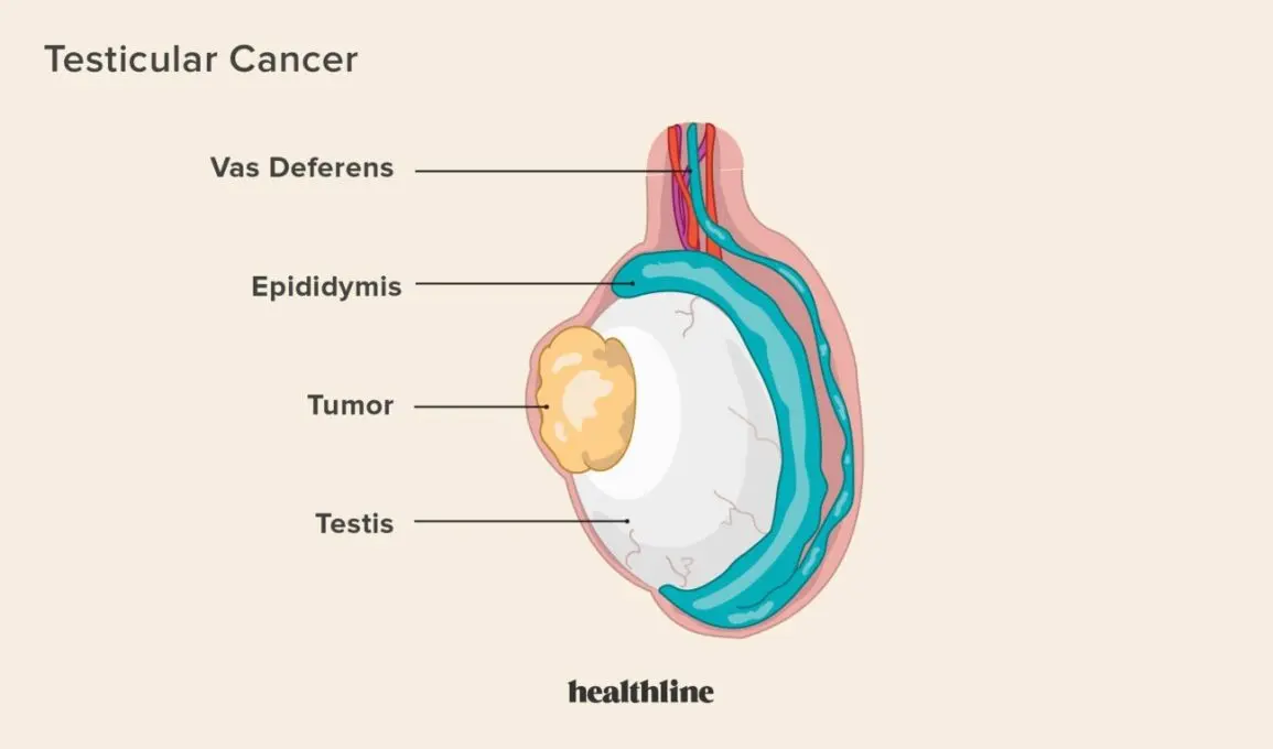 Tumors of the testicles &#8211; types, causes, symptoms, treatment