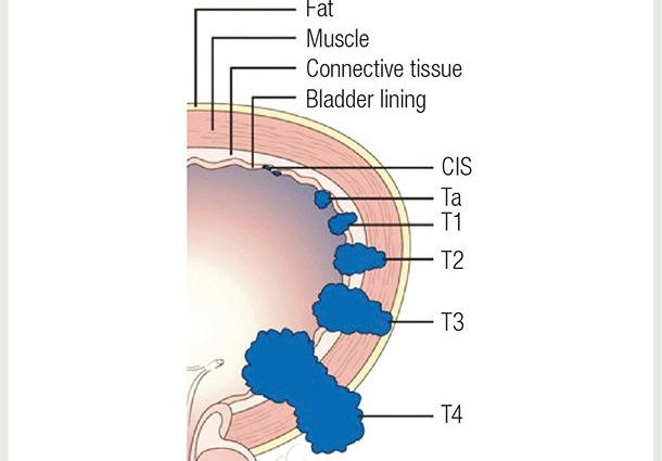 Tumors of the urinary tract