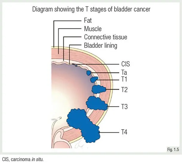 Tumors of the urinary tract