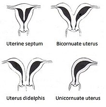 Two-horned uterus