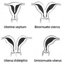 Two-horned uterus