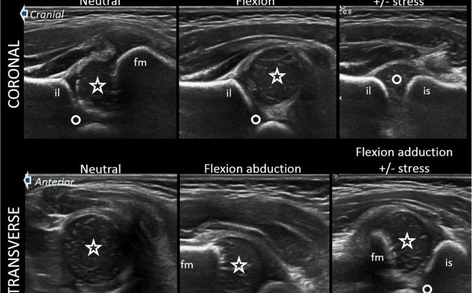 Ultrasound of a child&#8217;s hip joints. What does the test look like and when? [WE EXPLAIN]