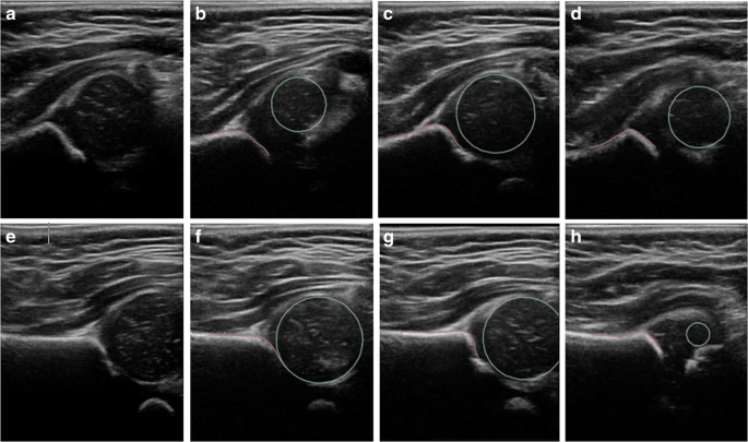 Ultrasound of an infant&#8217;s hips. What is hip dysplasia?