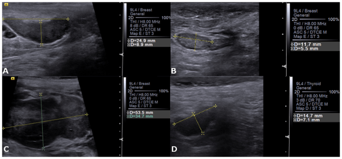 Ultrasound of lymph nodes &#8211; when to check? How to prepare for ultrasound of lymph nodes?