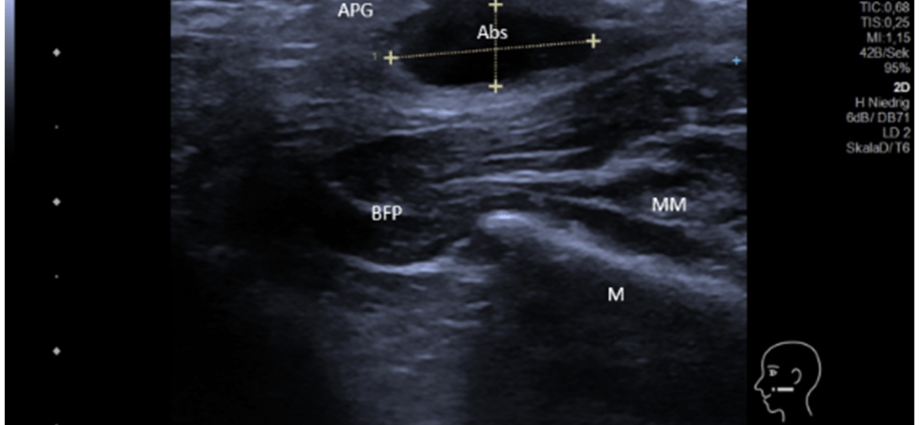 Ultrasound of the salivary glands &#8211; when to do and how to prepare for it?