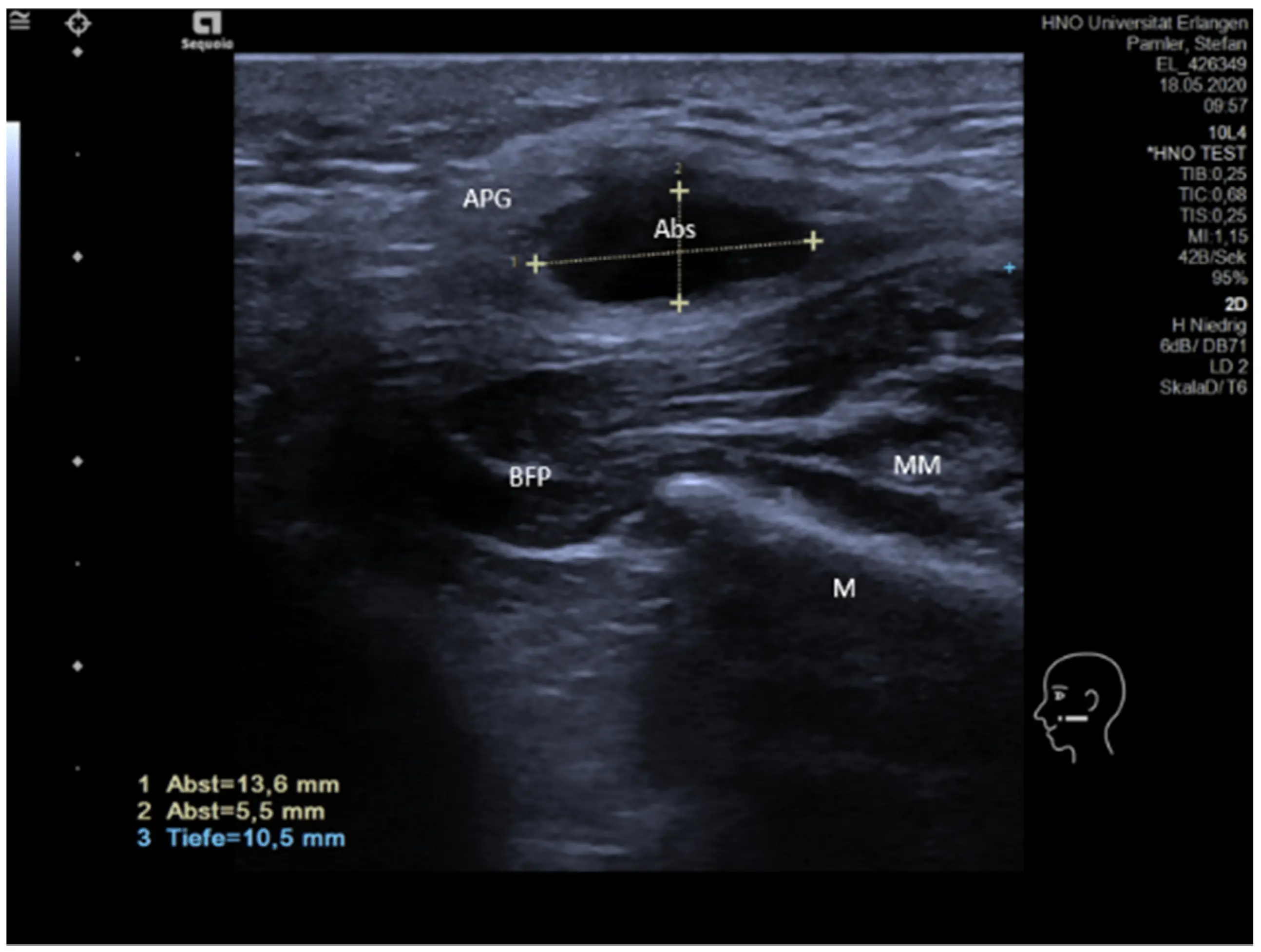 Ultrasound of the salivary glands &#8211; when to do and how to prepare for it?