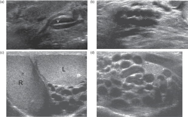 Ultrasound of the testes and scrotum in the diagnosis of infertility