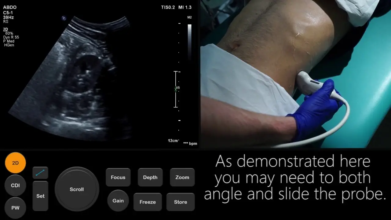 Ultrasound of the urinary system &#8211; indications, preparation, course