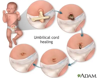 Umbilical cord stump &#8211; care for a newborn&#8217;s navel. What to do when festering?