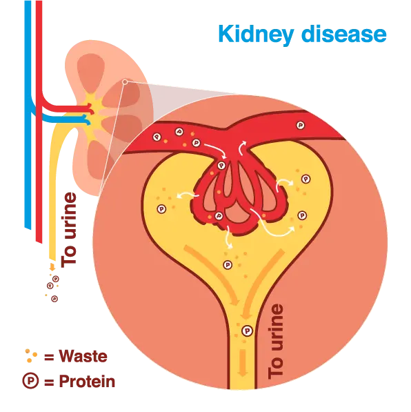 Untreated diabetes leads to serious kidney disease. What is nephropathy?