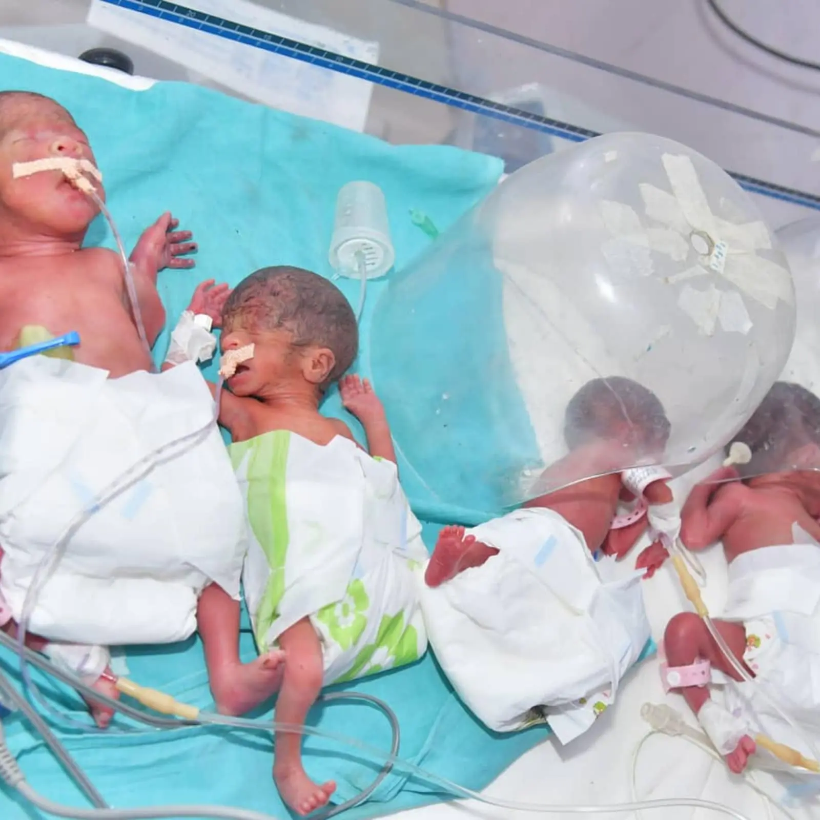 Unusual childbirth in Bydgoszcz. Quadruplets were born