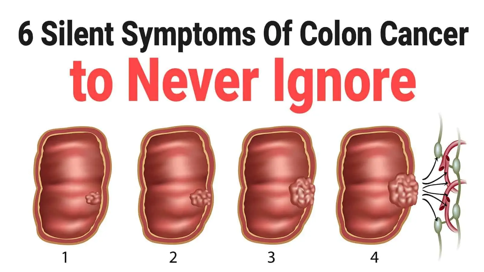 Unusual symptoms of colon cancer that we have been ignoring for years