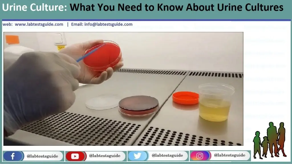 Urine culture &#8211; preparation for the test and interpretation of the results