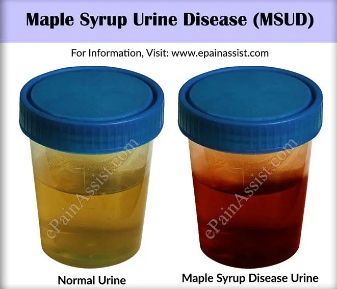 Urine smells sweet? It could be maple syrup disease