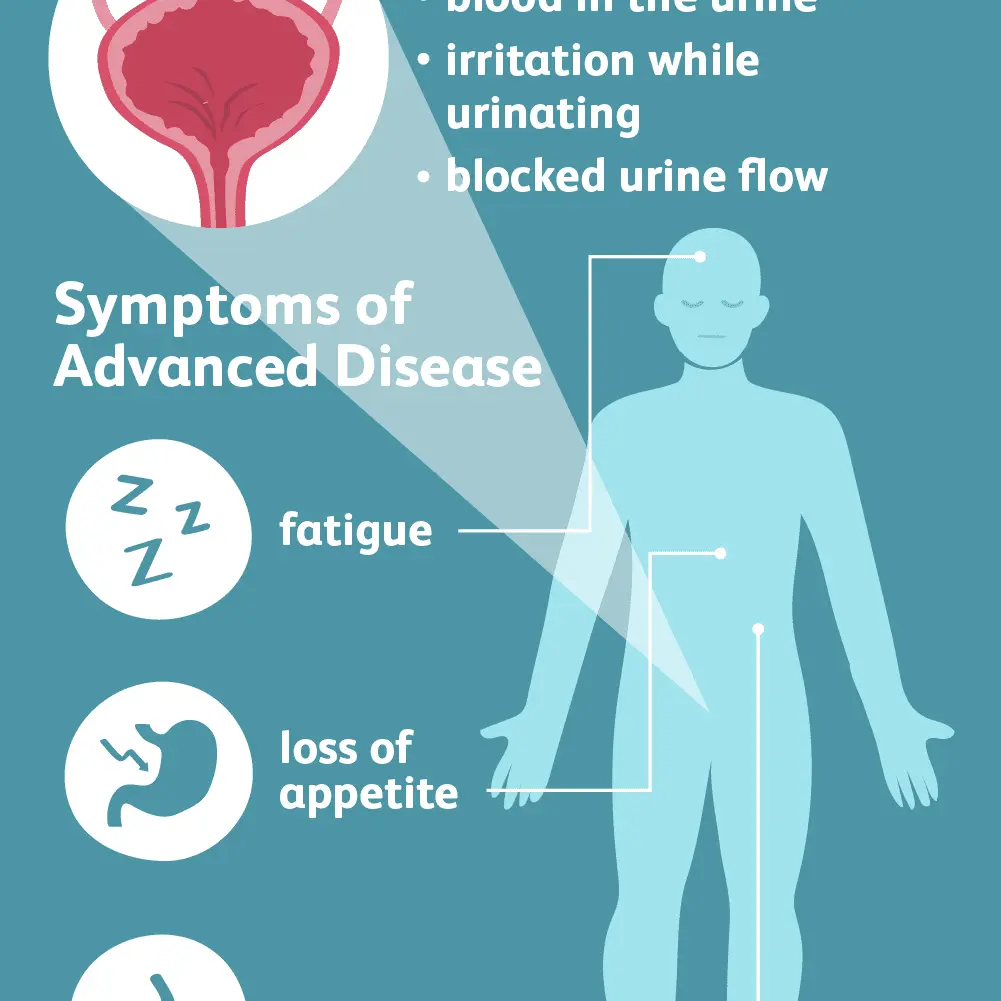 Urological neoplasms. Two serious symptoms that must not be ignored &#8211; may be a sign of cancer