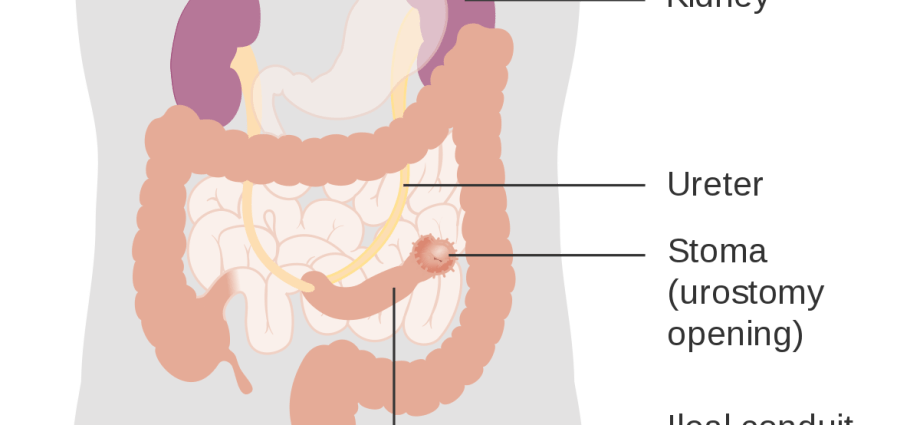 Urostomy &#8211; what is it?