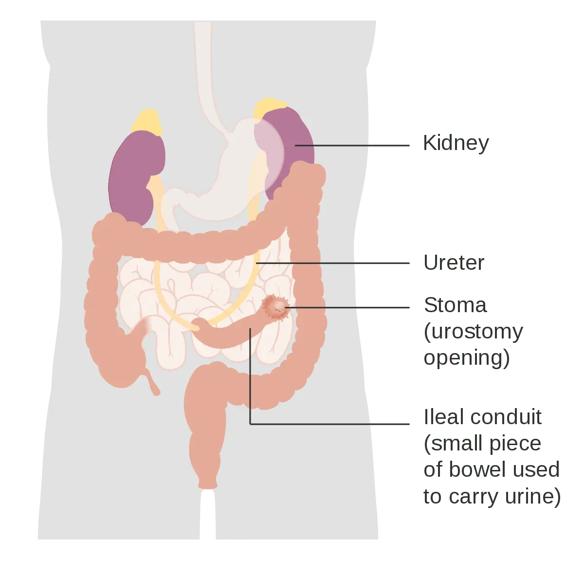 Urostomy &#8211; what is it?