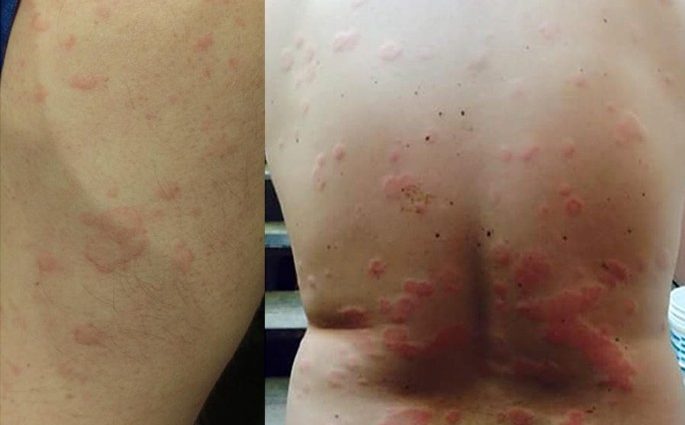 Urticaria and angioedema