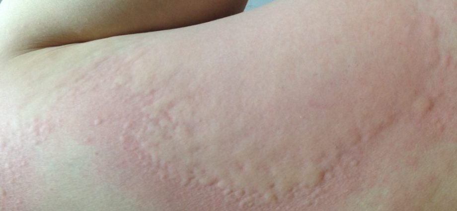 Urticaria bubble &#8211; symptoms, appearance, location