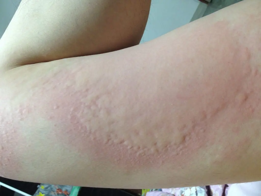 Urticaria bubble &#8211; symptoms, appearance, location