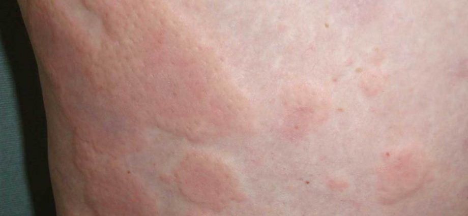 Urticaria &#8211; causes, types, treatment. What diseases cause hives?