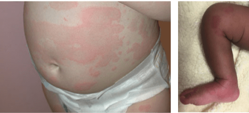 urticaria-in-children-causes-symptoms-treatment-what-is-hives-in