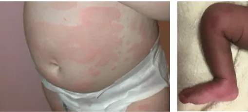 Urticaria in children &#8211; causes, symptoms, treatment. What is hives in children and when does it appear?