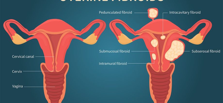 Uterine fibroids &#8211; diagnosis, symptoms, removal of uterine fibroids. These tumors are up to 80 percent. women