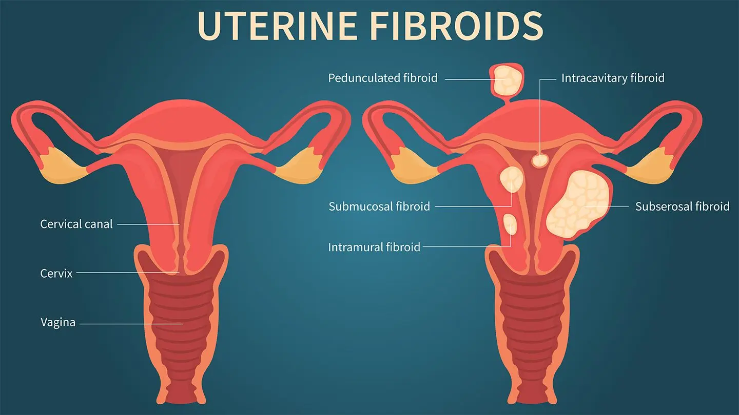 Uterine fibroids &#8211; diagnosis, symptoms, removal of uterine fibroids. These tumors are up to 80 percent. women