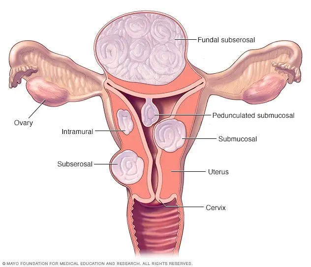 Uterine fibroids