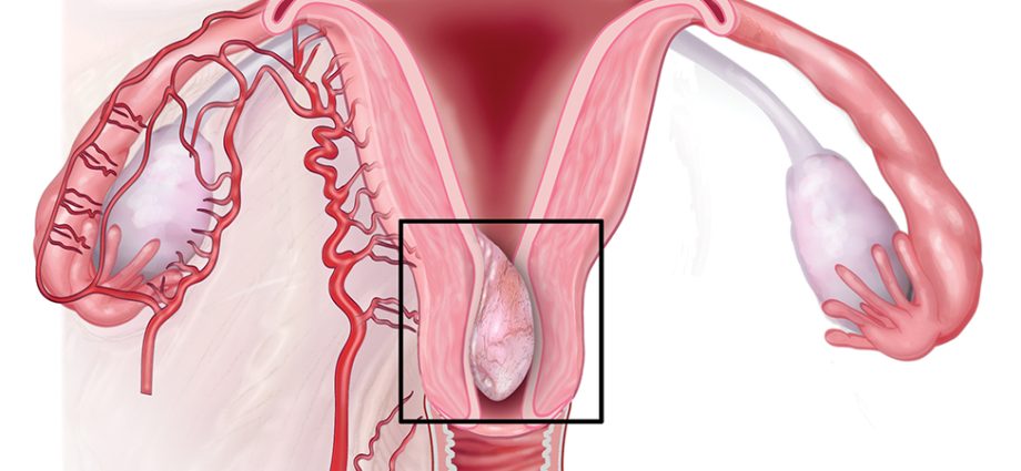 Uterine polyps &#8211; what is the treatment like?