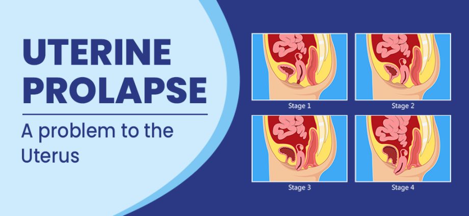 Uterine prolapse &#8211; causes, symptoms, treatment, prevention