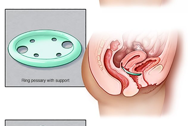 Uterine prolapse &#8211; what treatment is possible?