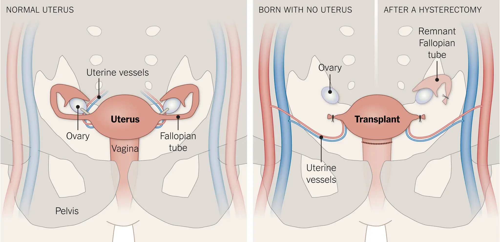 Uterus transplant