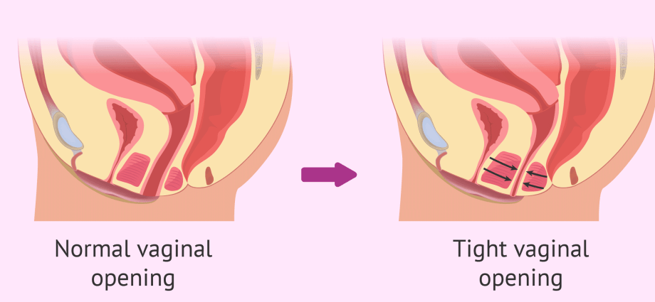 Vaginismus. A disease that takes the joy out of close-ups