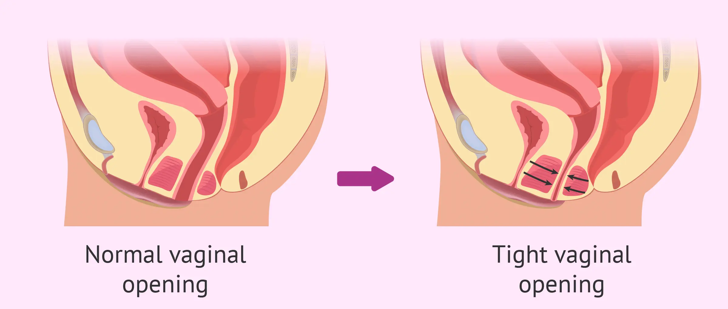 Vaginismus. A disease that takes the joy out of close-ups