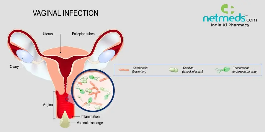 Vaginitis &#8211; bacterial or fungal? Types of intimate infections