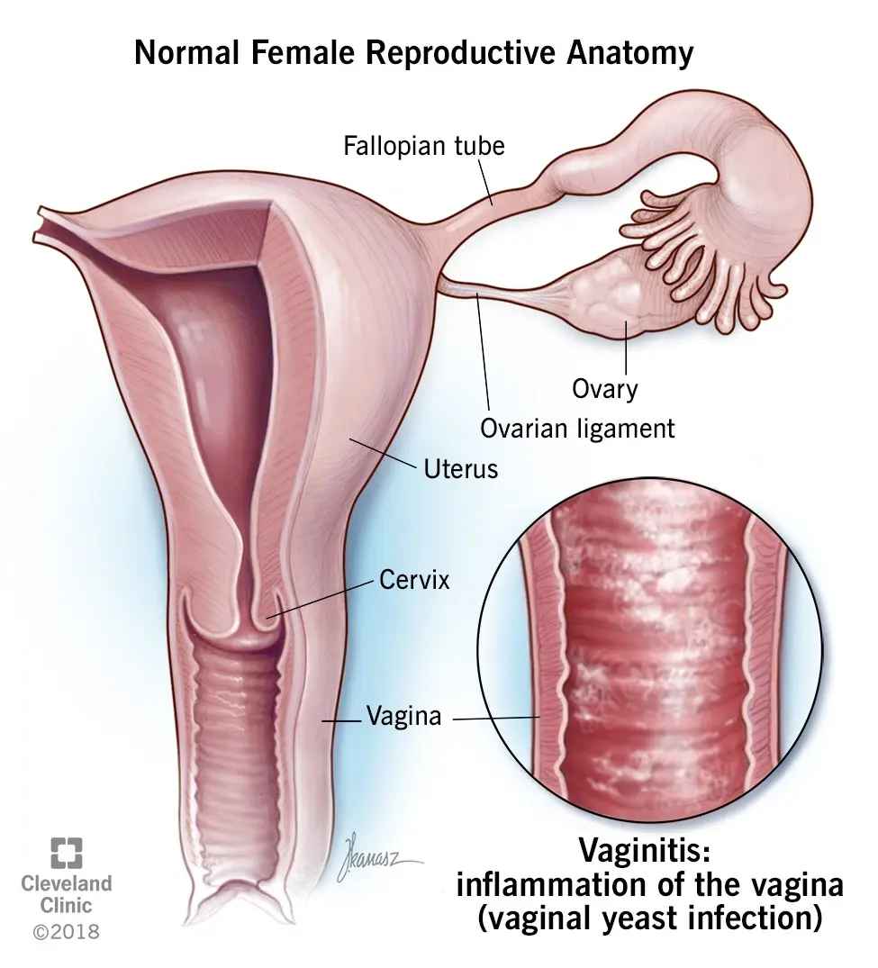 Vaginitis &#8211; causes, treatment [WE EXPLAIN]