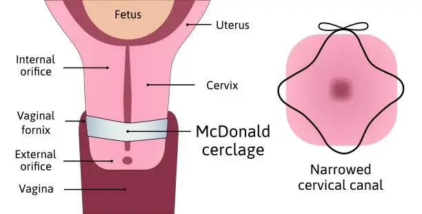 Vaginoplasty &#8211; indications, course, effects and price of the procedure