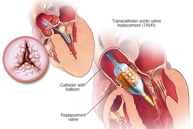 Valve implantation through the tip of the heart